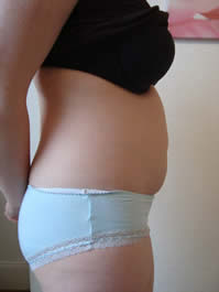 Before laser lipolysis (Smartlipo) treatment for abdomen