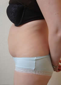 Before laser lipolysis (Smartlipo) treatment for abdomen