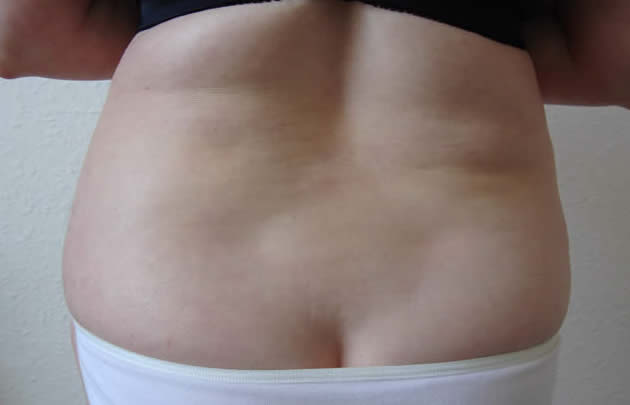 heat rash pictures. Please note, the heat rash in