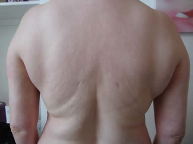 Before laser lipolysis (Smartlipo) treatment for double chin