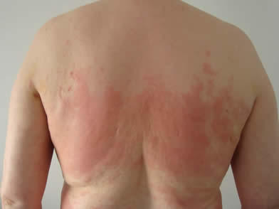 After laser lipolysis (Smartlipo) treatment for back