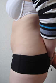 After laser lipolysis (Smartlipo) treatment for abdomen