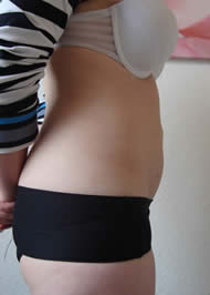 After laser lipolysis (Smartlipo) treatment for abdomen