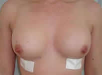 Front view of breasts immediately after Macrolane treatment showing large increase in size