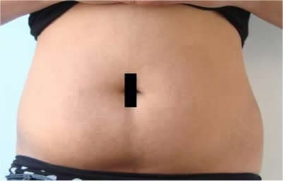 After laser lipolysis (Smartlipo) treatment for abdomen