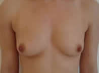 front view of breasts before Macrolane treatment