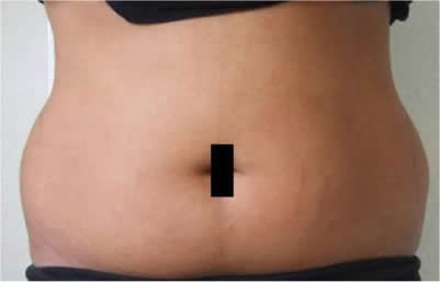Before laser lipolysis (Smartlipo) treatment for abdomen