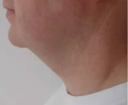 Before laser lipolysis (Smartlipo) treatment for double chin