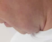 After laser lipolysis (Smartlipo) treatment for double chin