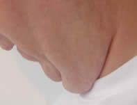 Before laser lipolysis (Smartlipo) treatment for double chin