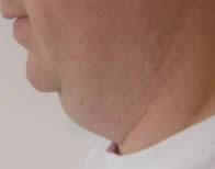 Before laser lipolysis (Smartlipo) treatment for double chin