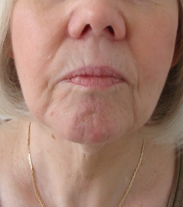 double chin after laser lipo